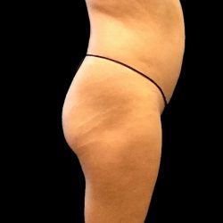 Brazilian Butt Lift Before & After Patient #2696