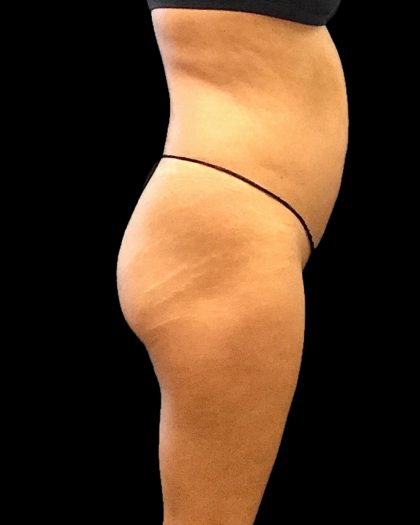 Brazilian Butt Lift Before & After Patient #2696