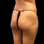 Brazilian Butt Lift Before & After Patient #2696