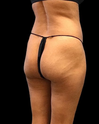 Brazilian Butt Lift Before & After Patient #2696
