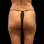 Brazilian Butt Lift Before & After Patient #2696