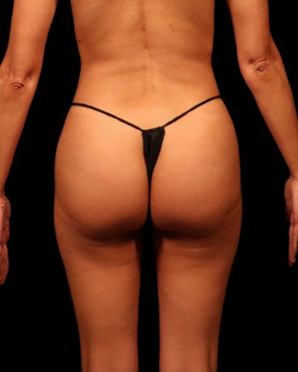 Brazilian Butt Lift Before & After Patient #2696