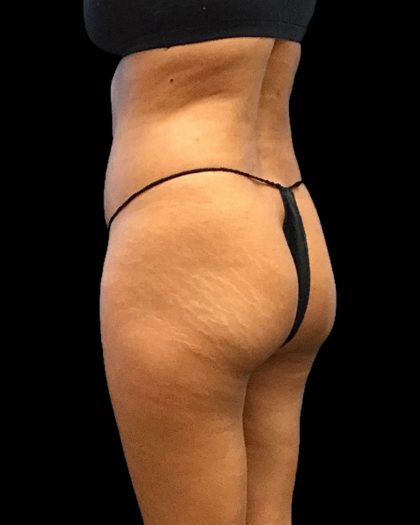 Brazilian Butt Lift Before & After Patient #2696