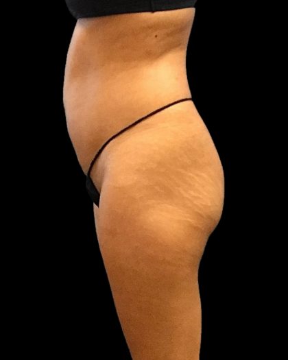 Brazilian Butt Lift Before & After Patient #2696