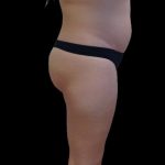 Brazilian Butt Lift Before & After Patient #2697