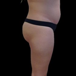 Brazilian Butt Lift Before & After Patient #2697