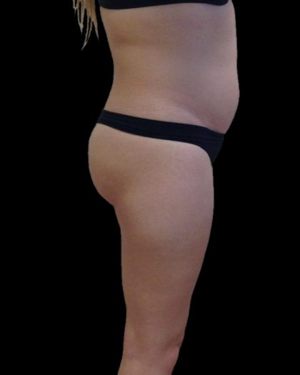 Brazilian Butt Lift Before & After Patient #2697