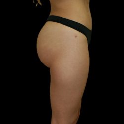 Brazilian Butt Lift Before & After Patient #2697