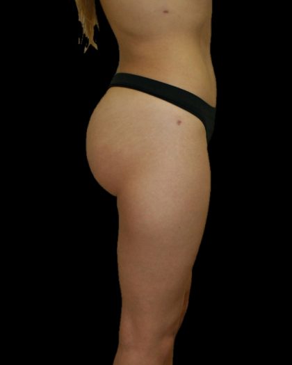 Brazilian Butt Lift Before & After Patient #2697