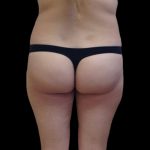 Brazilian Butt Lift Before & After Patient #2697