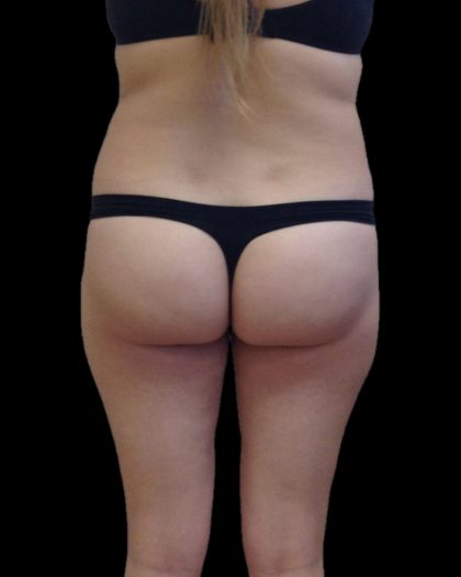 Brazilian Butt Lift Before & After Patient #2697