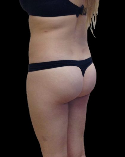 Brazilian Butt Lift Before & After Patient #2697