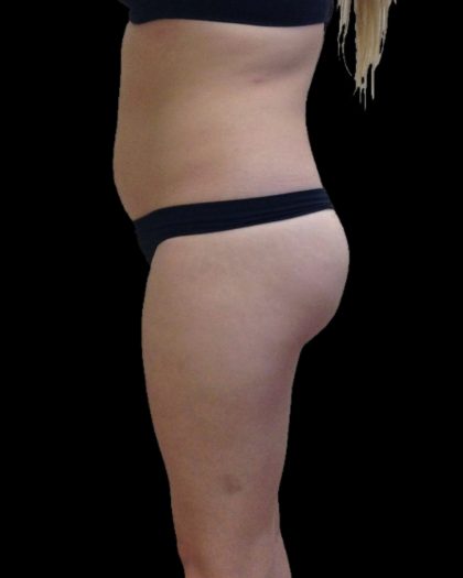Brazilian Butt Lift Before & After Patient #2697