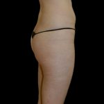 Brazilian Butt Lift Before & After Patient #2698
