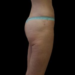 Brazilian Butt Lift Before & After Patient #2698