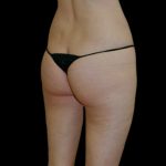 Brazilian Butt Lift Before & After Patient #2698