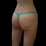 Brazilian Butt Lift Before & After Patient #2698