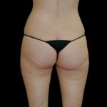 Brazilian Butt Lift Before & After Patient #2698