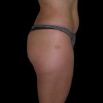 Brazilian Butt Lift Before & After Patient #2699