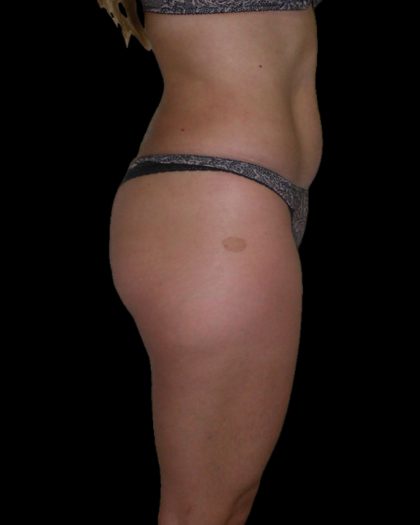 Brazilian Butt Lift Before & After Patient #2699