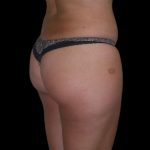 Brazilian Butt Lift Before & After Patient #2699