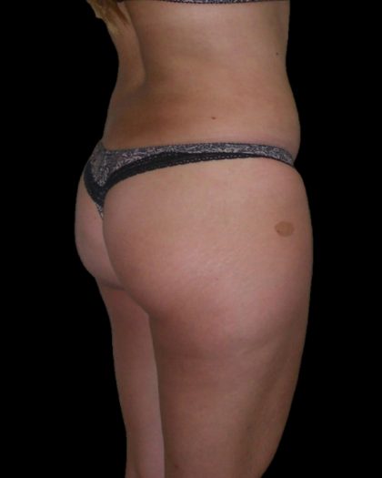 Brazilian Butt Lift Before & After Patient #2699
