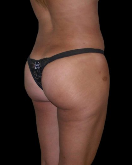 Brazilian Butt Lift Before & After Patient #2699