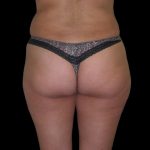 Brazilian Butt Lift Before & After Patient #2699