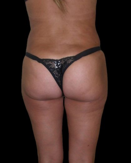 Brazilian Butt Lift Before & After Patient #2699