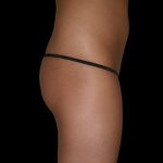 Brazilian Butt Lift Before & After Patient #2700