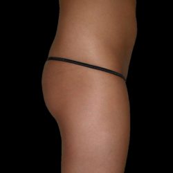Brazilian Butt Lift Before & After Patient #2700