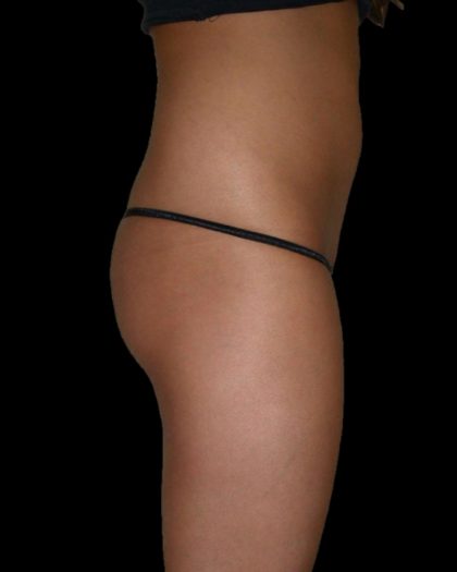 Brazilian Butt Lift Before & After Patient #2700