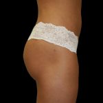 Brazilian Butt Lift Before & After Patient #2700