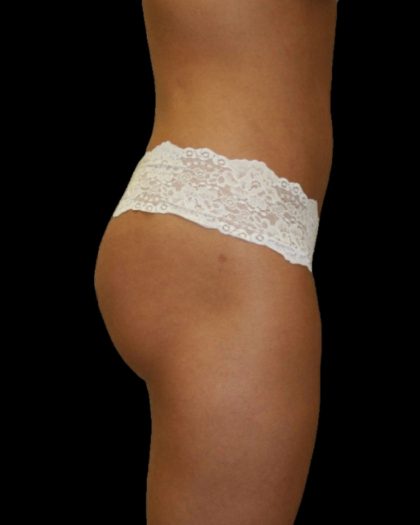 Brazilian Butt Lift Before & After Patient #2700