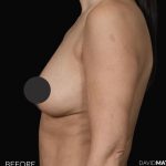 Breast Augmentation Before & After Patient #2762