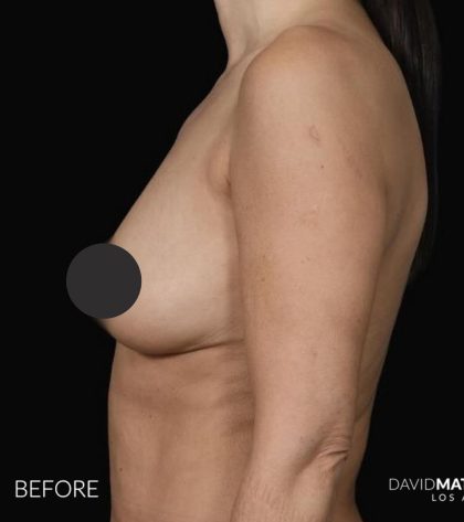 Breast Augmentation Before & After Patient #2762