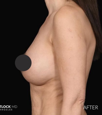 Breast Augmentation Before & After Patient #2762