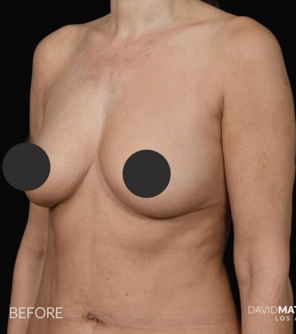 Breast Augmentation Before & After Patient #2762