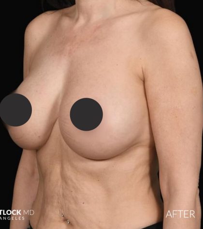 Breast Augmentation Before & After Patient #2762