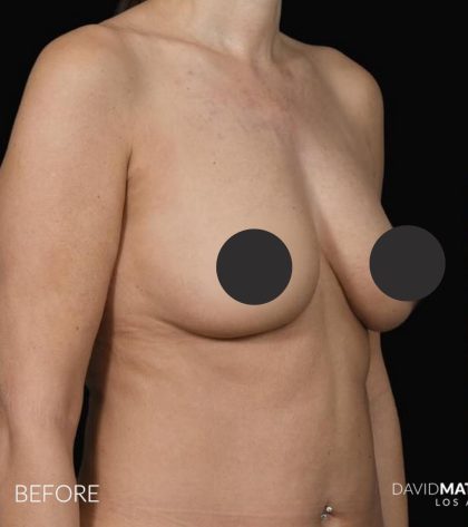 Breast Augmentation Before & After Patient #2762