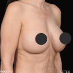 Breast Augmentation Before & After Patient #2762