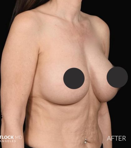 Breast Augmentation Before & After Patient #2762