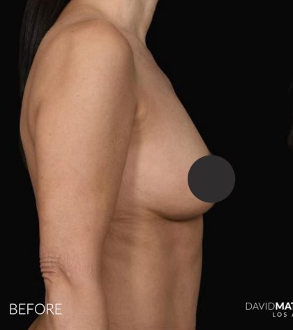 Breast Augmentation Before & After Patient #2762