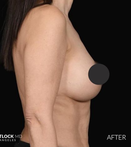 Breast Augmentation Before & After Patient #2762