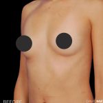 Breast Augmentation Before & After Patient #2753