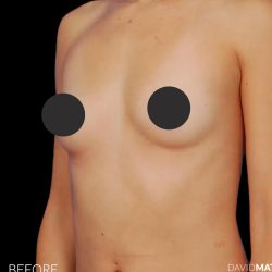 Breast Augmentation Before & After Patient #2753