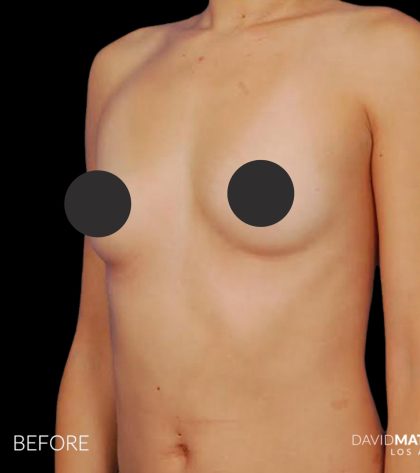 Breast Augmentation Before & After Patient #2753