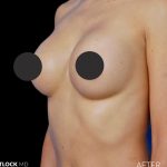 Breast Augmentation Before & After Patient #2753