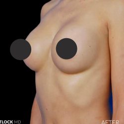 Breast Augmentation Before & After Patient #2753
