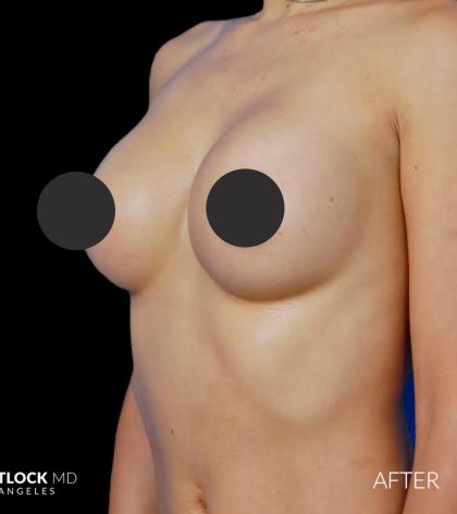 Breast Augmentation Before & After Patient #2753